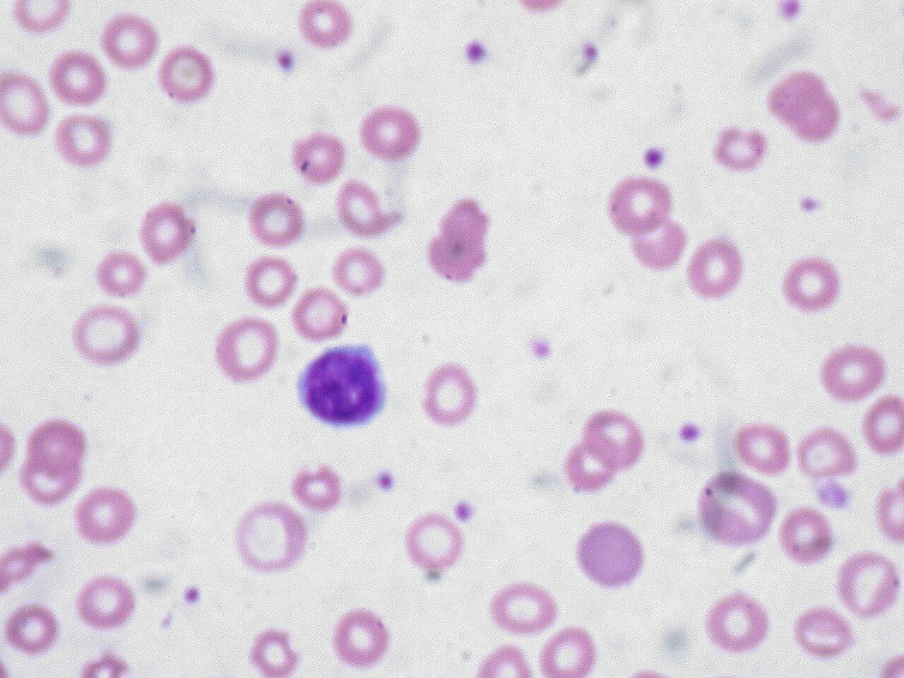 Anemia: Recognizing the Symptoms and Blood-Boosting Foods