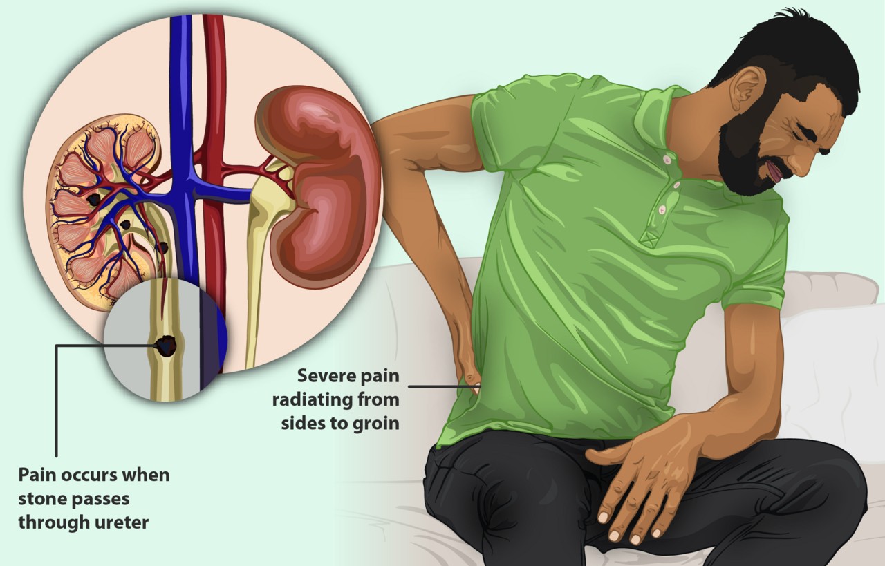 Kidney Stone Symptoms and Dietary Restrictions