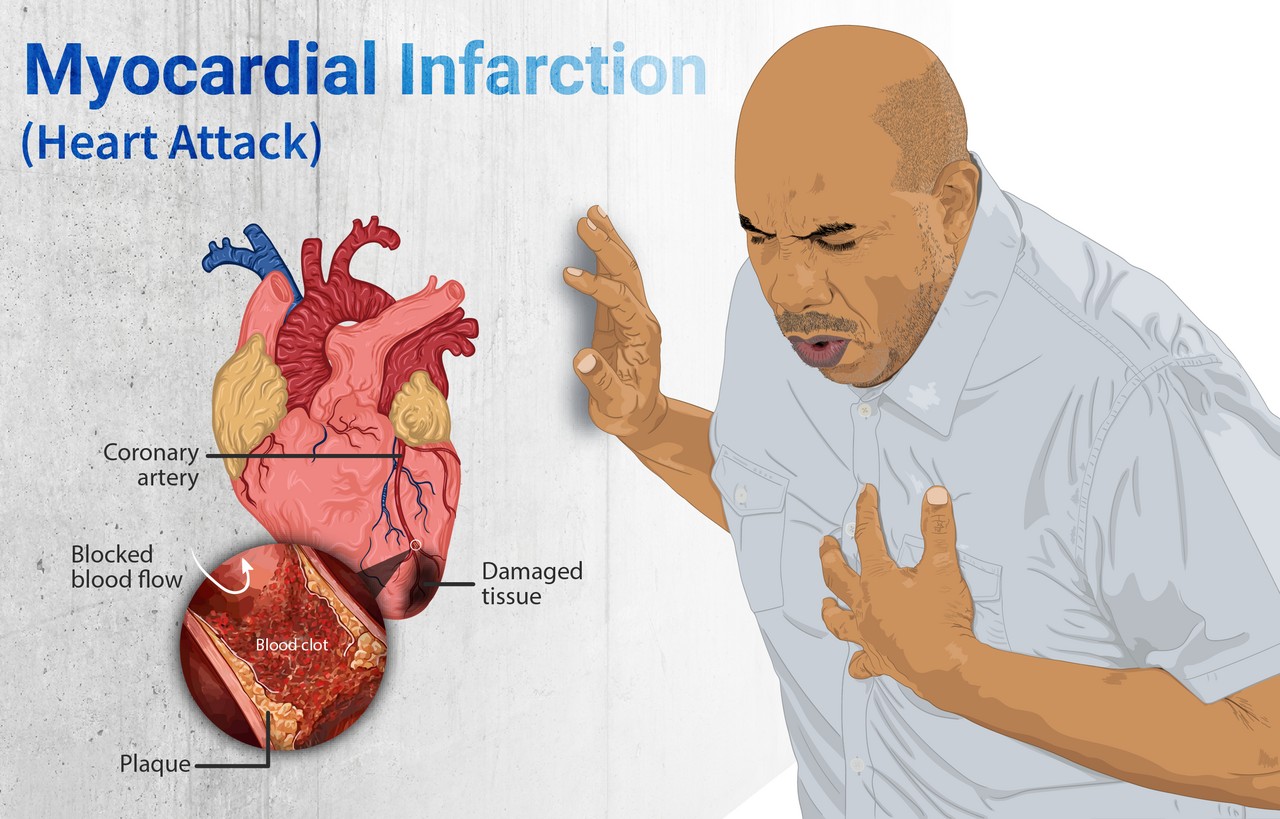 Heart Attack Symptoms You Must Recognize Early