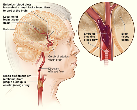 Gejala Stroke dan Pertolongan Pertama yang Menentukan Nyawa