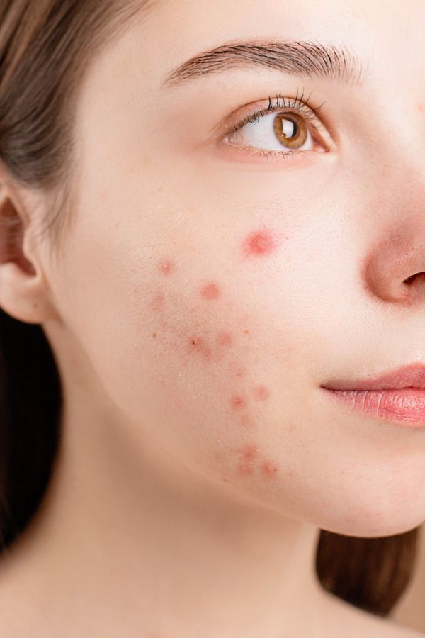 Acne: Causes and How to Treat It from Mild to Severe