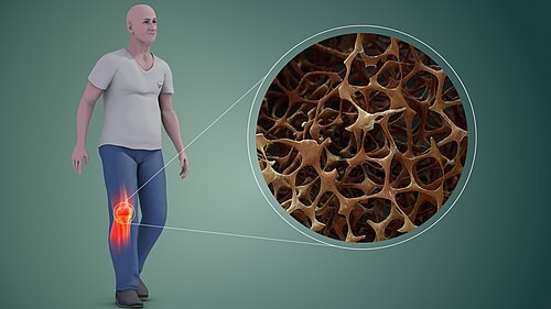 Osteoporosis: Kenali Gejala dan Cara Mencegah Tulang Keropos