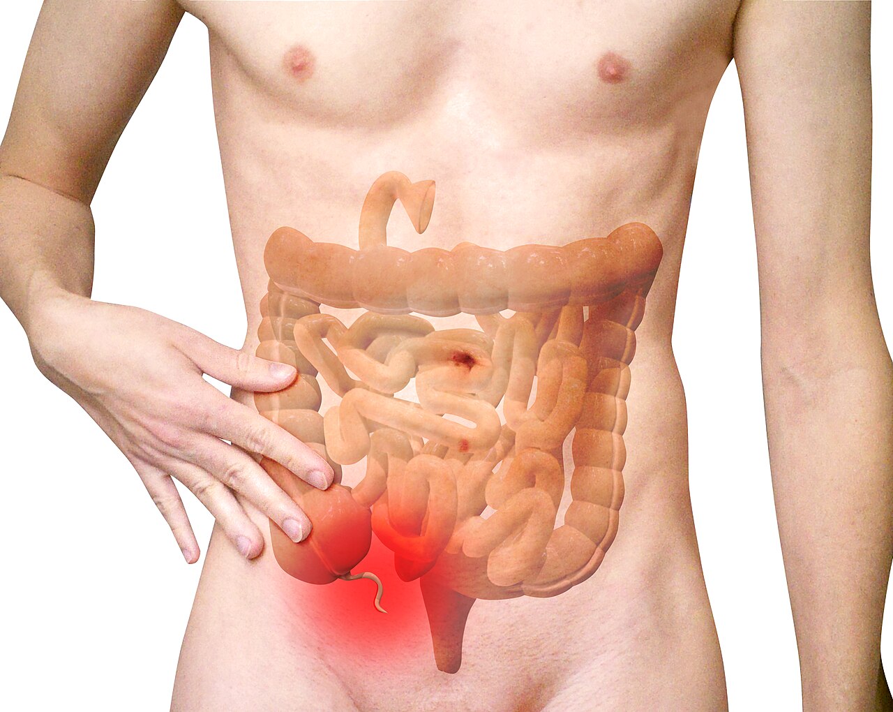 Appendicitis: Symptoms You Must Not Ignore